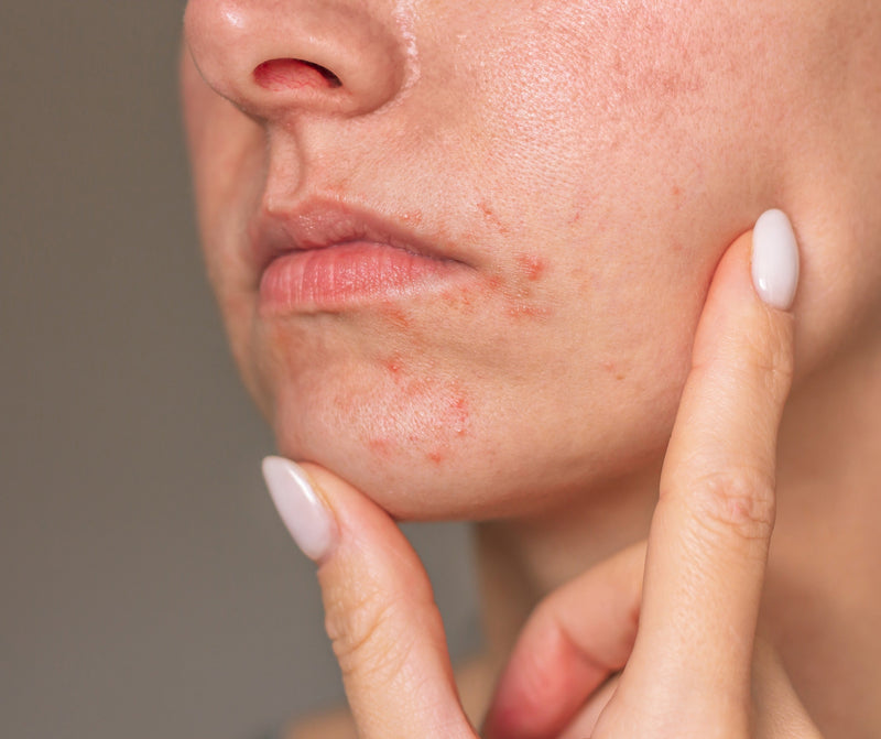 Was ist Periorale Dermatitis?