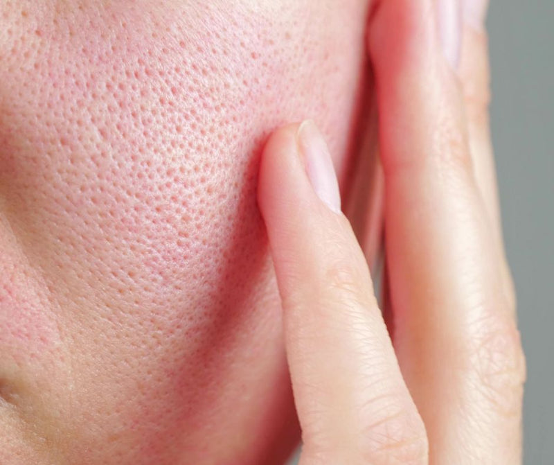 Was tun gegen große Poren? Diese Methoden helfen, sie zu verfeinern!