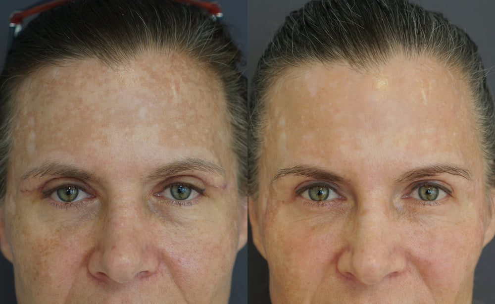 Ruth V. vorher-nachher