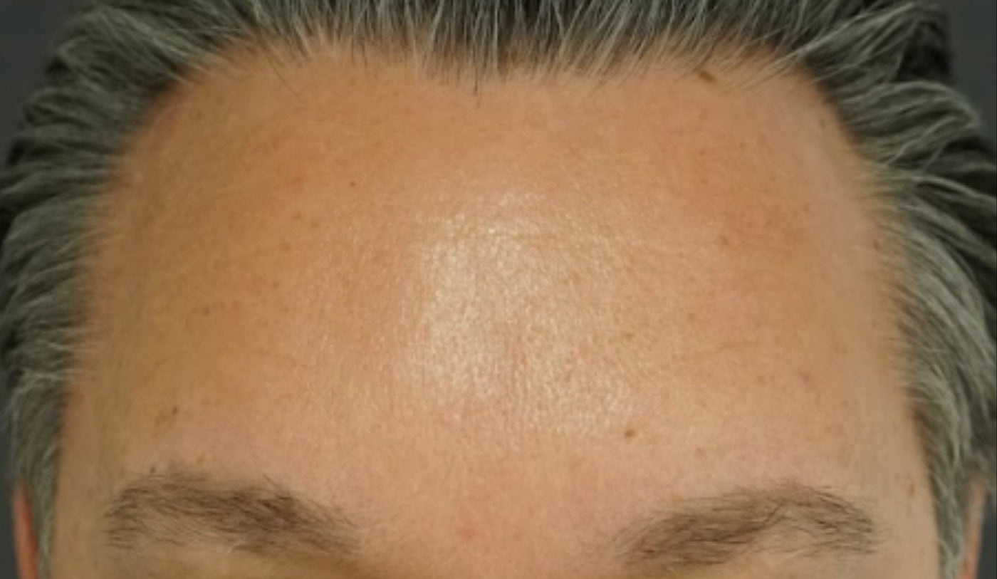 DOC BERGER EFFECT Hyper Hyaluron Serum: After Results