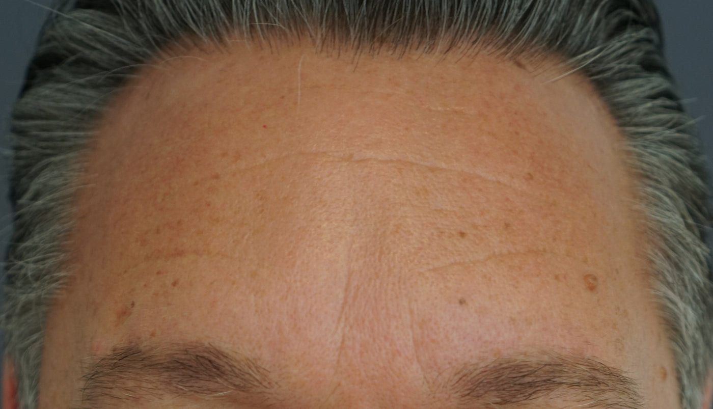 DOC BERGER EFFECT Hyper Hyaluron Serum: Before and After Results