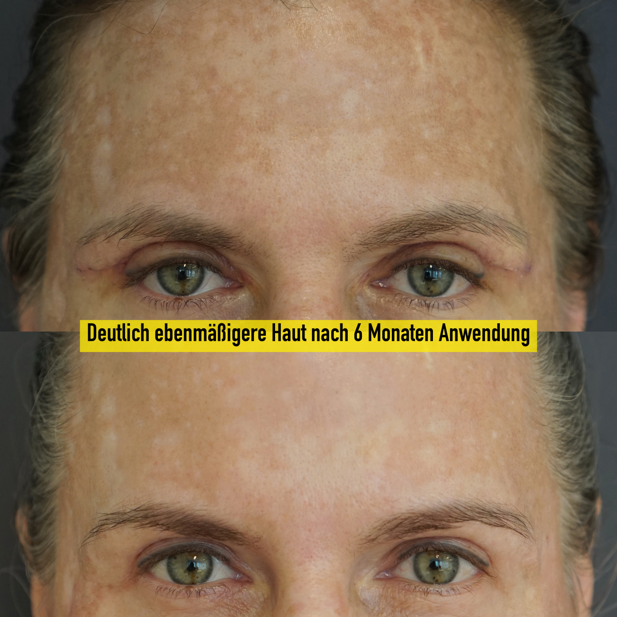 deutlich ebenmäßigere haut nach 6 monaten anwendung