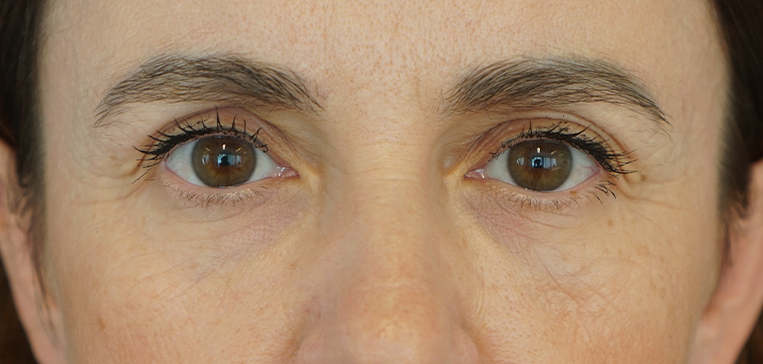 nachher bild von Kundin mit tiefen falten nach der doc berger effect behandlung mit retinol und vitamin C+ Serum