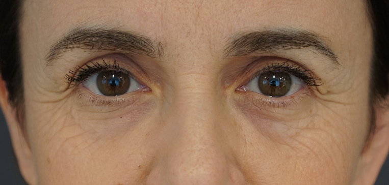 vorher bild von Kundin mit tiefen falten vor der doc berger effect behandlung mit retinol und vitamin C+ Serum